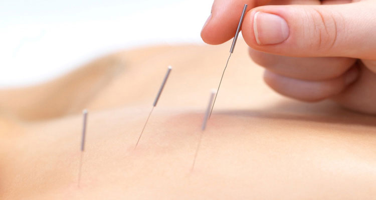 Akupunktur İzmir
